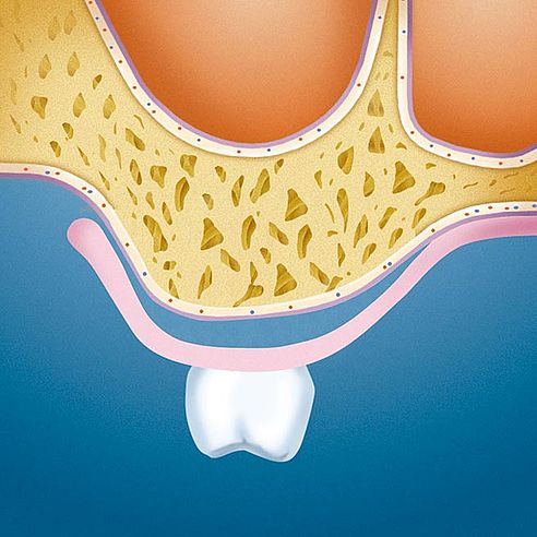 Cavities beneath jaw ridge and denture | Protefix
